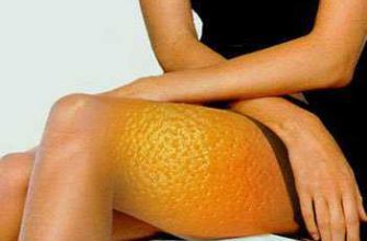 'апельсиновой коркой'